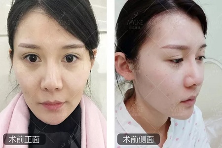 顏值：做完自體脂肪填充15天后，她變啥樣了？