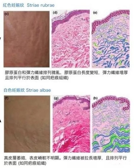 為什么瘦人也會(huì)有“肥胖紋”？