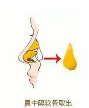 什么，隆鼻方式竟然有這么多種？