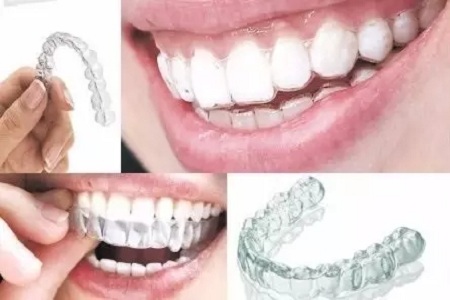 做牙齒矯正 ，真的要趁早！