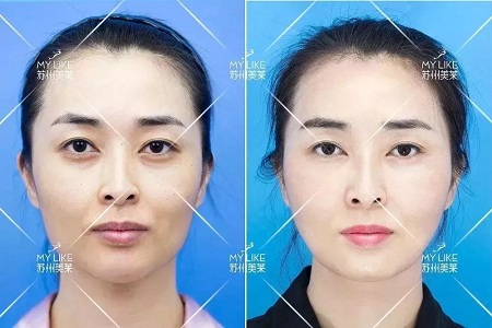 你討厭的脂肪，用在臉上就是寶貝！