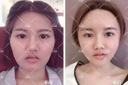 你討厭的脂肪，用在臉上就是寶貝！