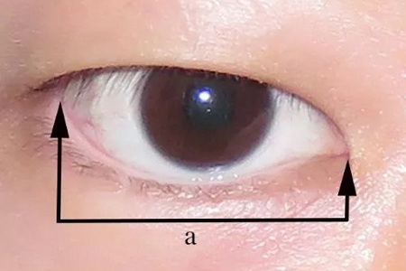 開眼角和不開眼角，差距有多大？