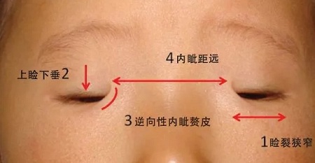 開眼角和不開眼角，差距有多大？