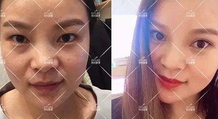 開眼角和不開眼角，差距有多大？