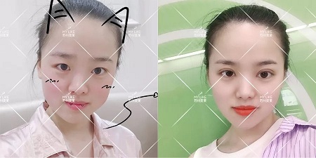 開眼角和不開眼角，差距有多大？