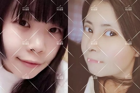 開眼角和不開眼角，差距有多大？