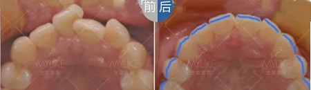 醫(yī)美白皮書：顏值爆表，全靠隱形牙套矯正！