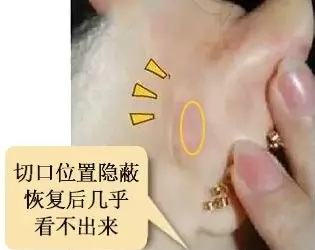 糾結！鼻頭太圓想塑形是用肋軟骨還是耳軟骨好？