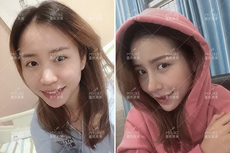 糾結！鼻頭太圓想塑形是用肋軟骨還是耳軟骨好？