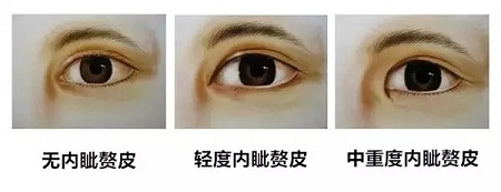 雙眼皮+開眼角為什么是較佳拍檔，一分鐘帶你看懂！