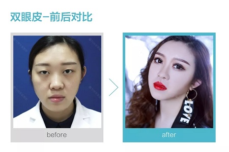 做了雙眼皮，醫(yī)師為什么建議要多睜眼？