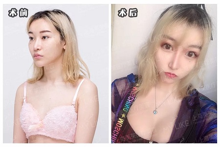 自體脂肪or假體隆胸，我到底應(yīng)該怎么選？