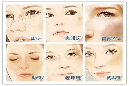 祛了那么多年的斑，你的斑去掉了嗎？