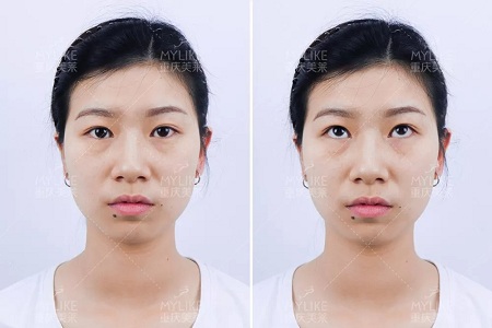 市面上五花八門的雙眼皮項目，如何有效找到你的菜？