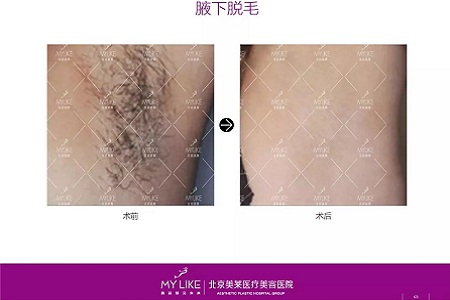 新品：黑科技脫毛金標(biāo)準(zhǔn)了解一下？