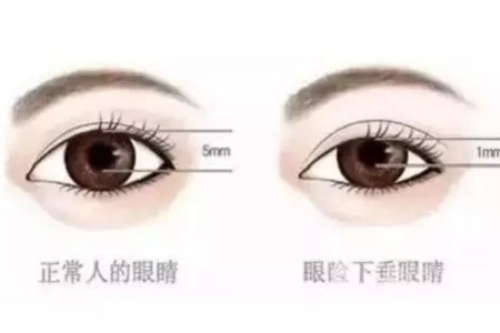 問診室：做雙眼皮前，這些問題你需要提前了解！