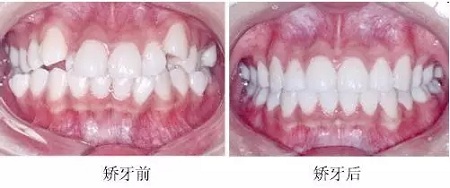 新品：整牙=換臉？隱適美IGO實現(xiàn)所有不可能！