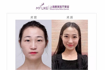 雙眼皮我想做埋線，為什么醫(yī)師建議我做全切雙眼皮