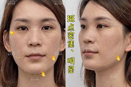 那個(gè)斑點(diǎn)女孩后來怎么樣了？