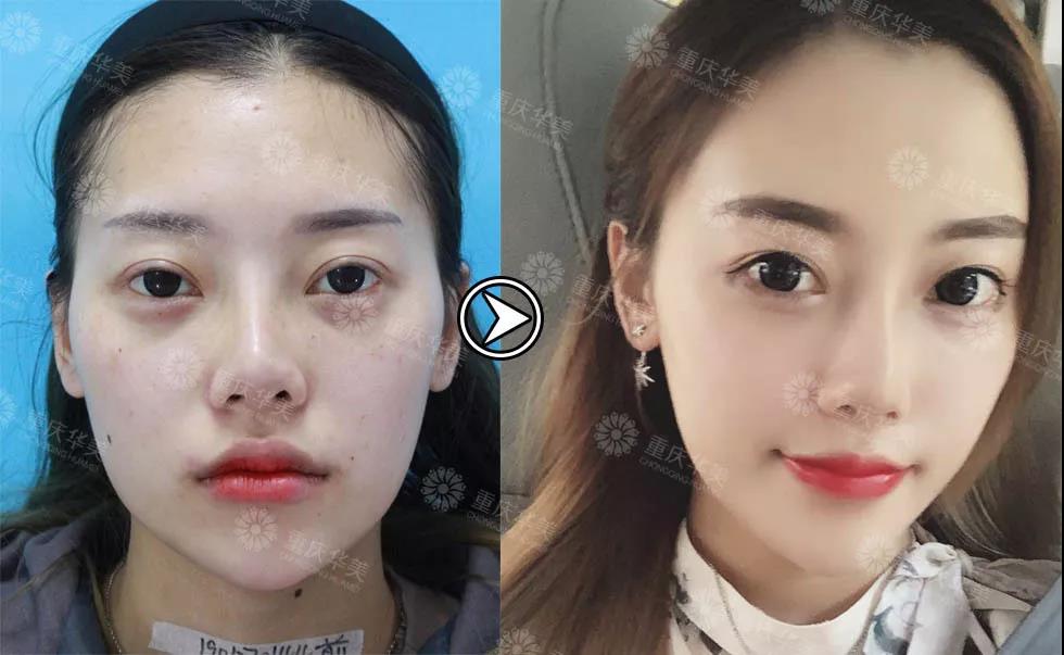 她減肥失敗100次，吸脂減肥后1個(gè)月逆襲變腿精