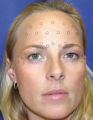 你無(wú)法用玻尿酸除掉所有皺紋！