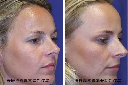 你無(wú)法用玻尿酸除掉所有皺紋！