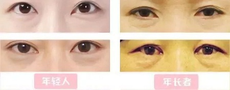 每到放假，做這個項目的人就會增多！--眼袋