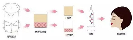 明星的臉和你的臉差的只是這一步！--面部脂肪填充