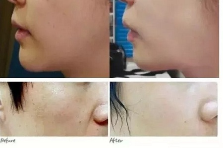 水光，打1次和4次究竟有多大區(qū)別？