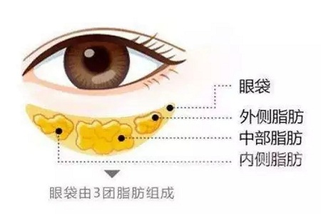 去掉眼袋，刻不容緩，別等又大又松弛才做