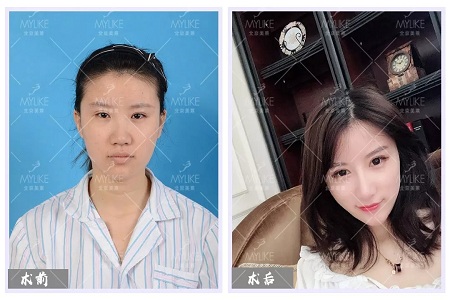 顏值：修復(fù)后的雙眼，美瞎一路