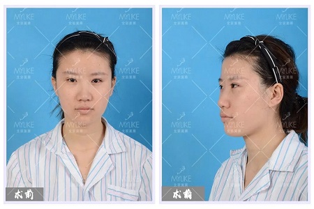 顏值：修復(fù)后的雙眼，美瞎一路