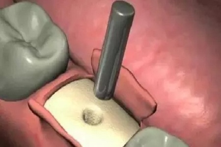 揭秘牙齒矯正的全過程?。?！