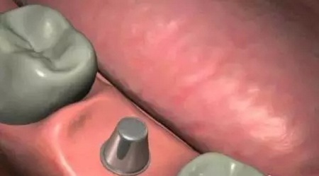 揭秘牙齒矯正的全過程！??！