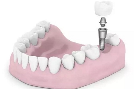 揭秘牙齒矯正的全過程?。?！