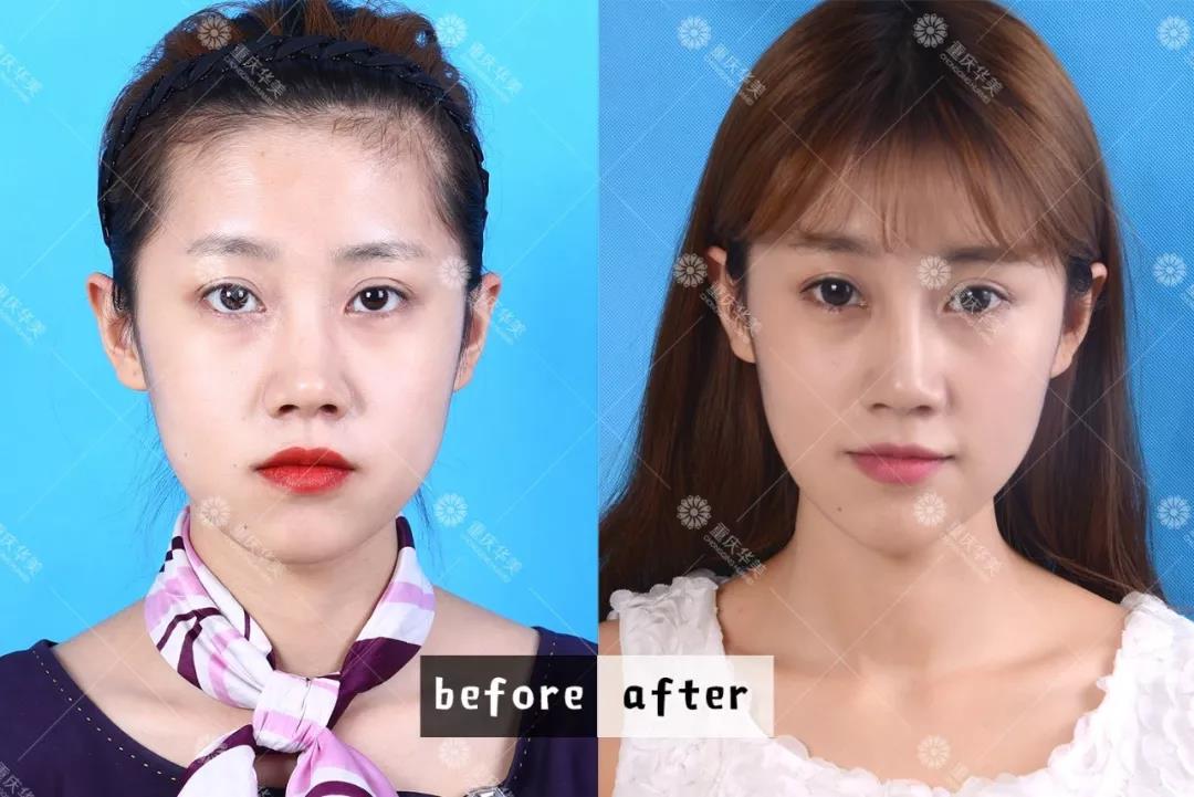 進口和國產(chǎn)瘦臉針有什么區(qū)別？2分鐘看懂