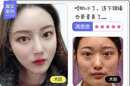 ?讓你擁有V臉、香肩、細(xì)腿的神器--玻尿酸的作用原理你真的知道嗎？