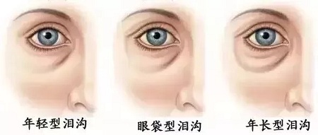 顯老淚溝，你還要任其放肆嗎？