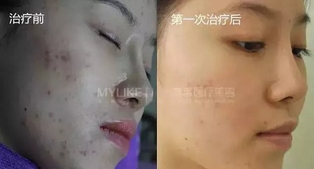 愛(ài)長(zhǎng)痘痘的你，應(yīng)該試試這道光！