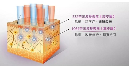 超皮秒激光祛斑，實(shí)力素顏，不加“斑”