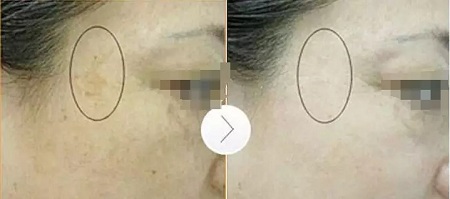 超皮秒激光祛斑，實(shí)力素顏，不加“斑”
