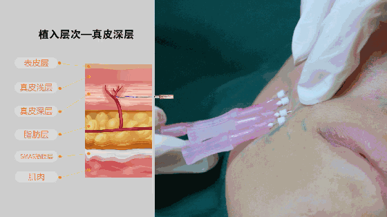 用玻尿酸治療鼻唇溝，一定要注意這種情況！