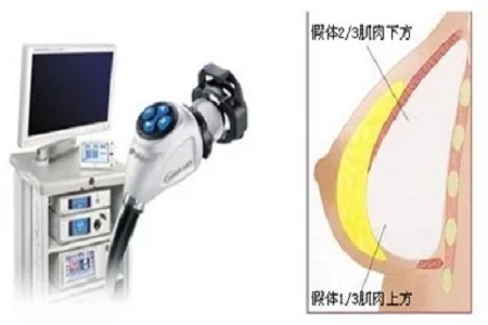 隆胸時醫(yī)師怎樣把直徑10cm的假體，塞入3cm的切口中的？