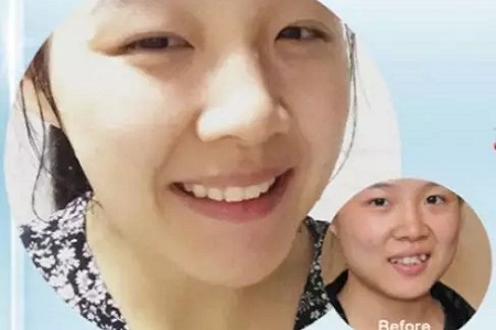 有效數(shù)據(jù)生成，預(yù)見牙齒矯正后的自己