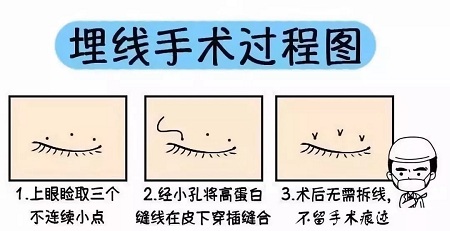 美眼張誠坐診美萊，淺談為什么你的眼睛不夠美？