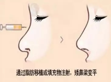 想知道身邊人有沒有做過隆鼻？看完這篇文章你就知道了