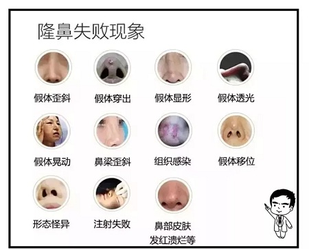 關(guān)于鼻整形修復(fù)，你需要知道的