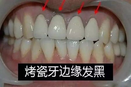 牙齒缺失時，選烤瓷牙還是那種？