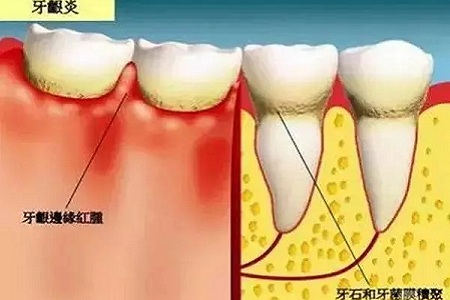 牙齒缺失時，選烤瓷牙還是那種？